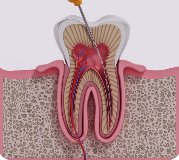 Dental Bridges Austin TX