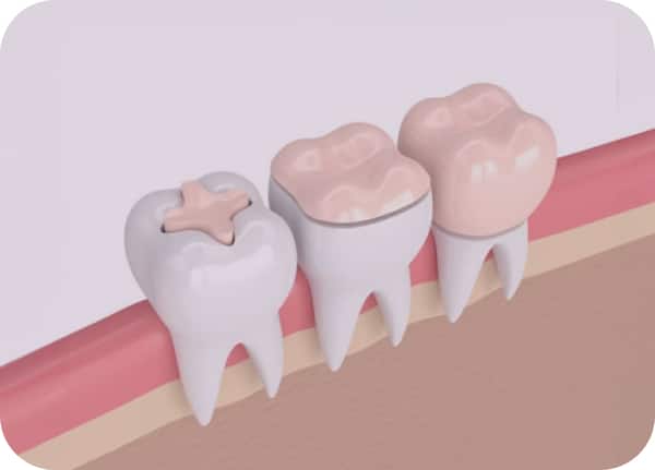 Composite Fillings Austin TX